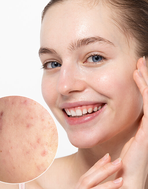 Anti acne, tini tisztító arckezelés, gyulladáscsökkentő fényterápia, 19 éves korig, kozmetika, Budapest, Nagy Eszter, Green Palm